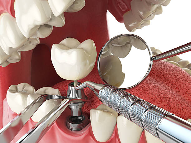 Best Emergency Dental Care for Broken or Chipped Teeth in Tavernier, FL
